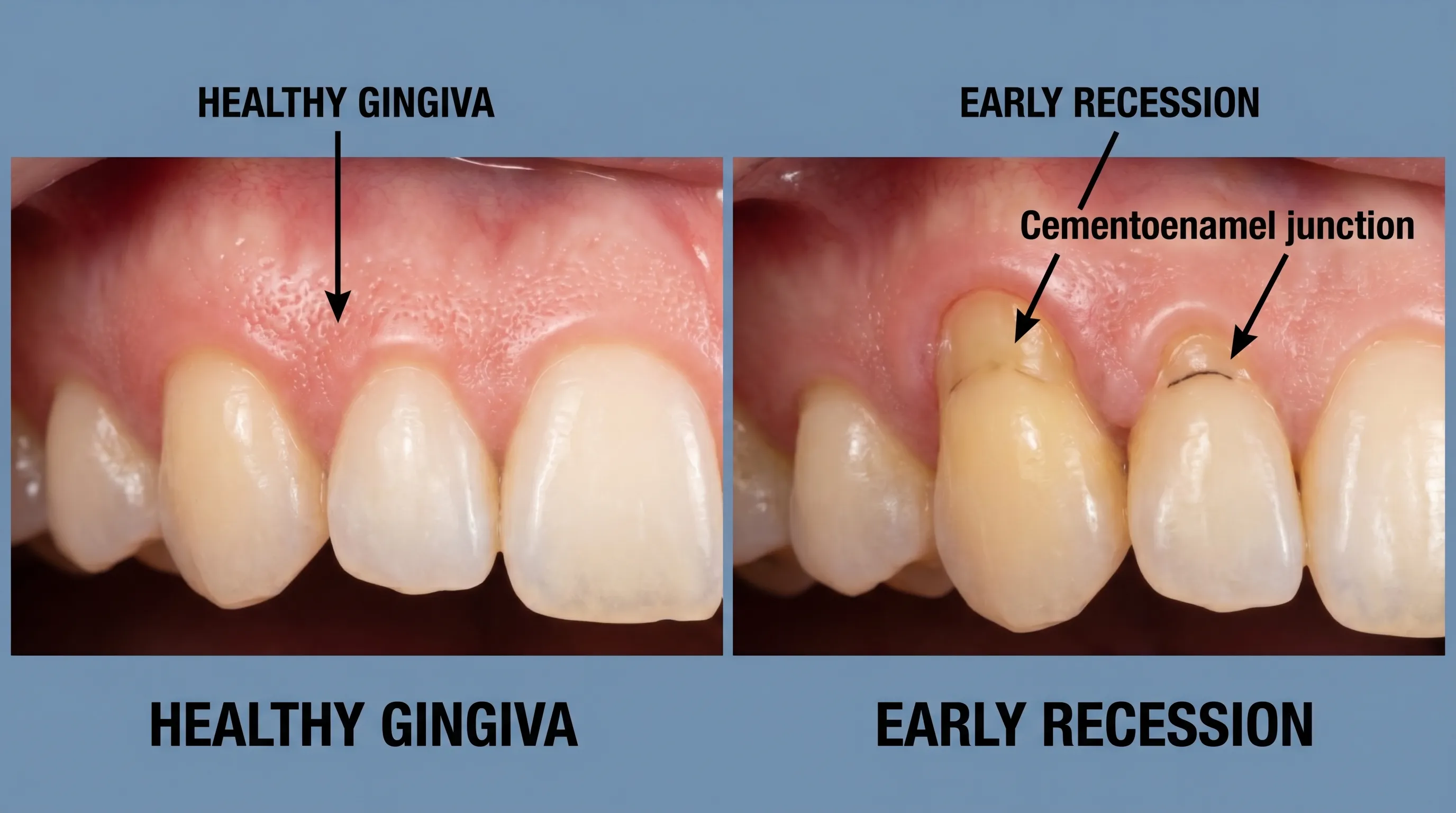 Clinical comparison of healthy gum tissue versus early-stage recession showing exposed tooth roots