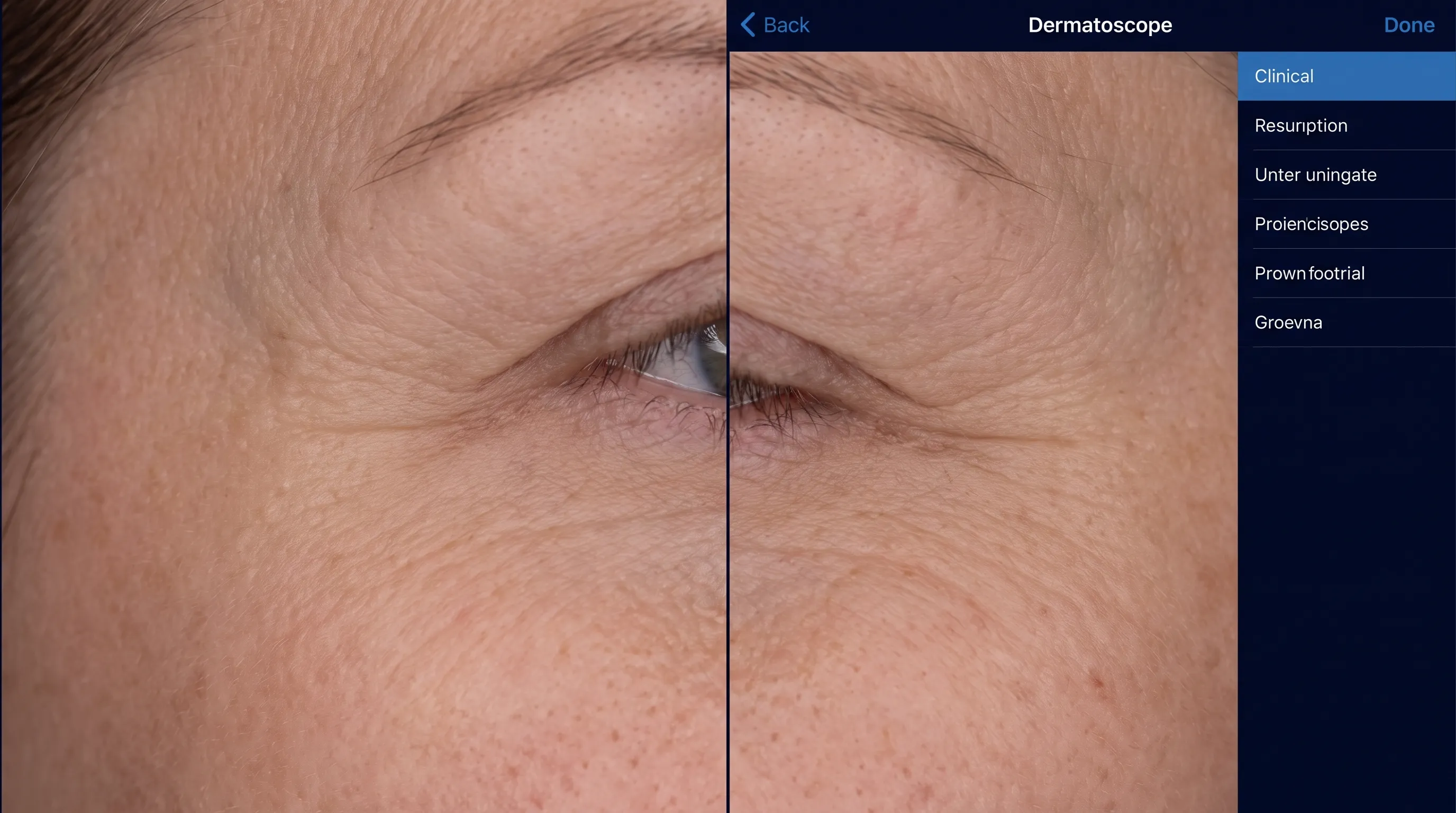 Close-up clinical dermatology image showing the delicate periorbital skin texture around the eye corner under magnification, medical educational style, neutral lighting