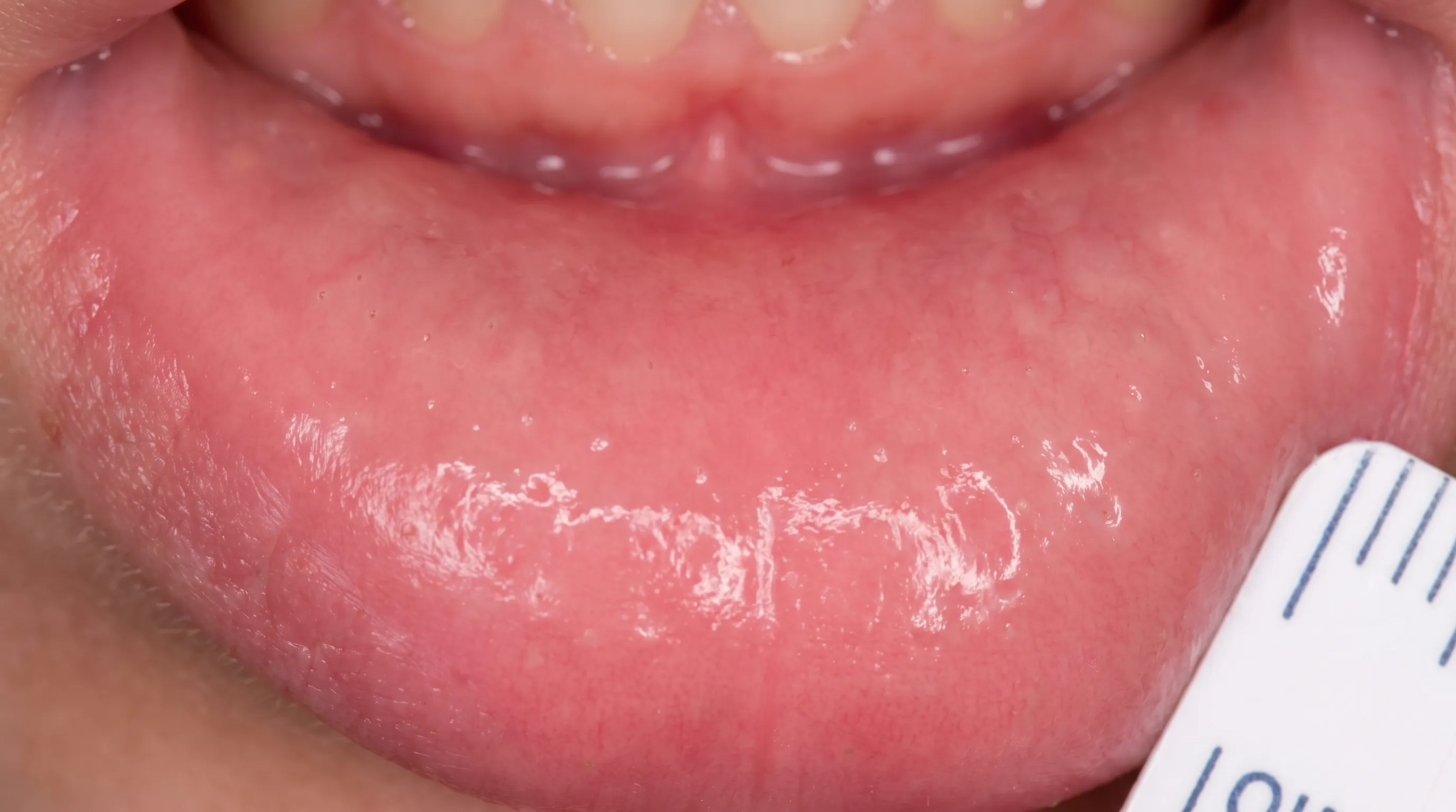 Cross-sectional view of oral mucosa showing minor salivary glands and duct structures