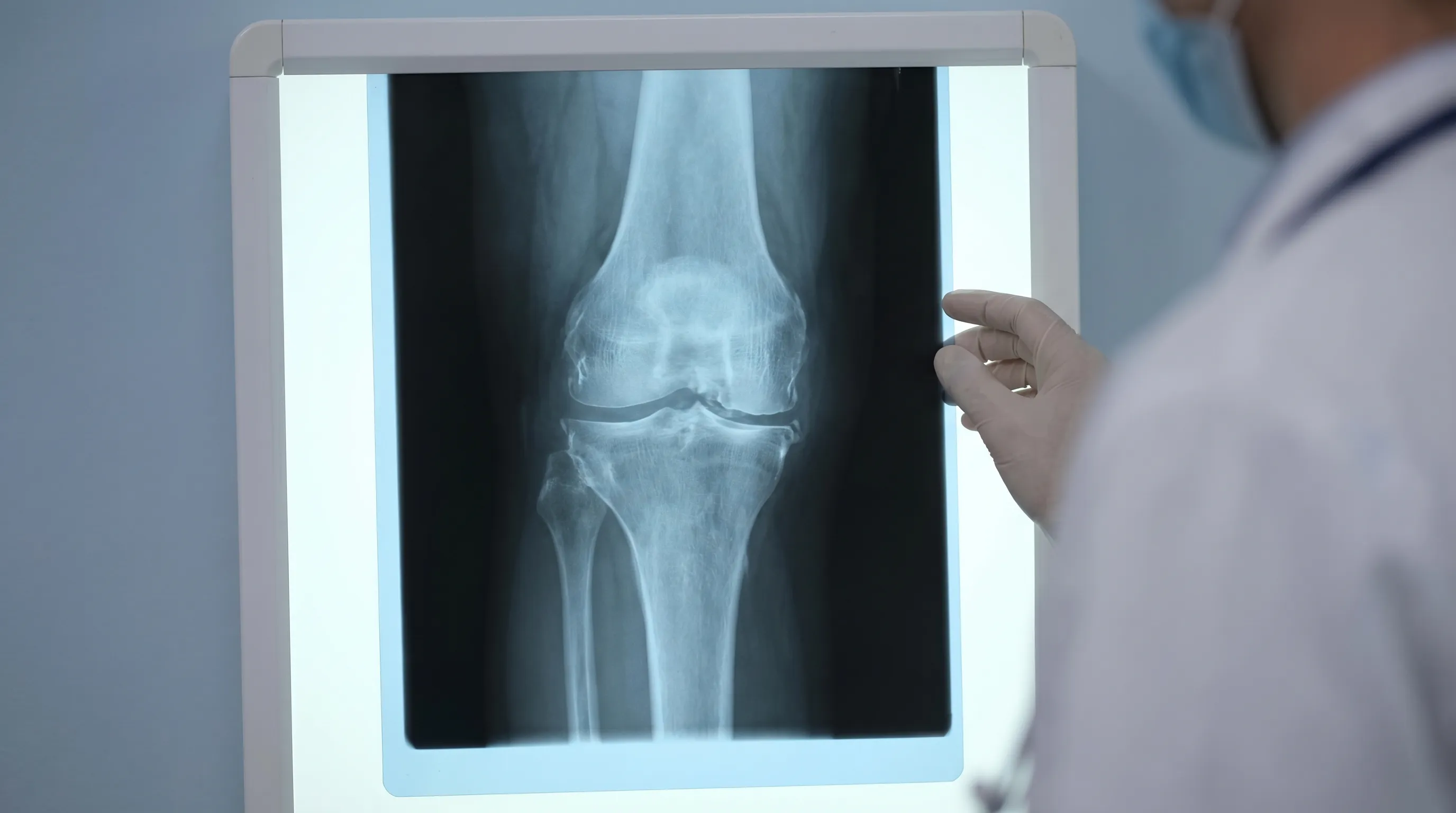 An anatomical X-ray of a human knee joint showing clear signs of advanced osteoarthritis, such as narrowed joint space and bone spurs.