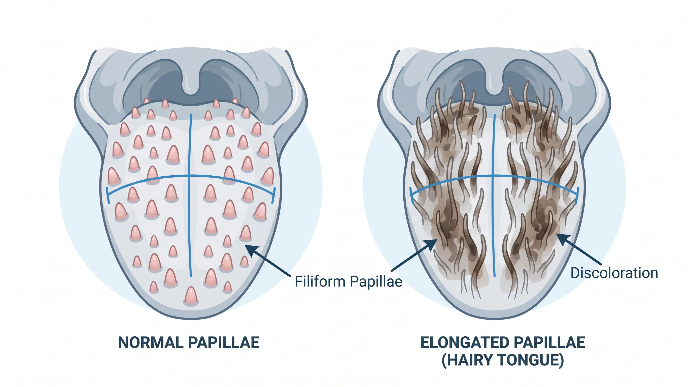 Close-up clinical illustration showing the dorsal surface of the tongue highlighting normal versus elongated filiform papillae with dark discoloration, medical diagram style, clean white background with subtle blue highlights