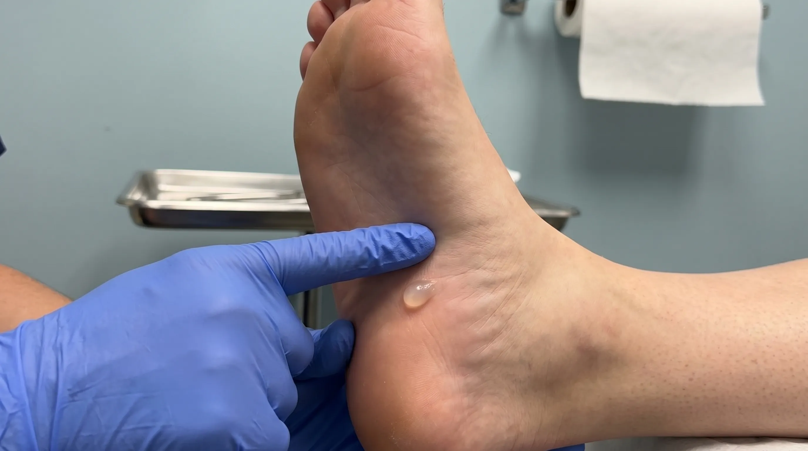 A close-up clinical photograph showing a podiatrist gently palpating the sole of a patient's foot while examining a small, smooth, translucent lump near the arch, set against a clean medical background.
