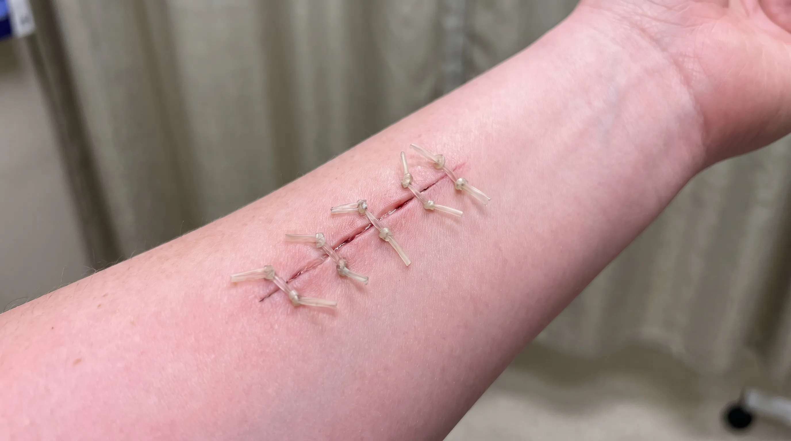 Close-up medical photo showing a healing incision with visible absorbable suture ends resting gently on the skin surface, clean clinical lighting, soft focus background