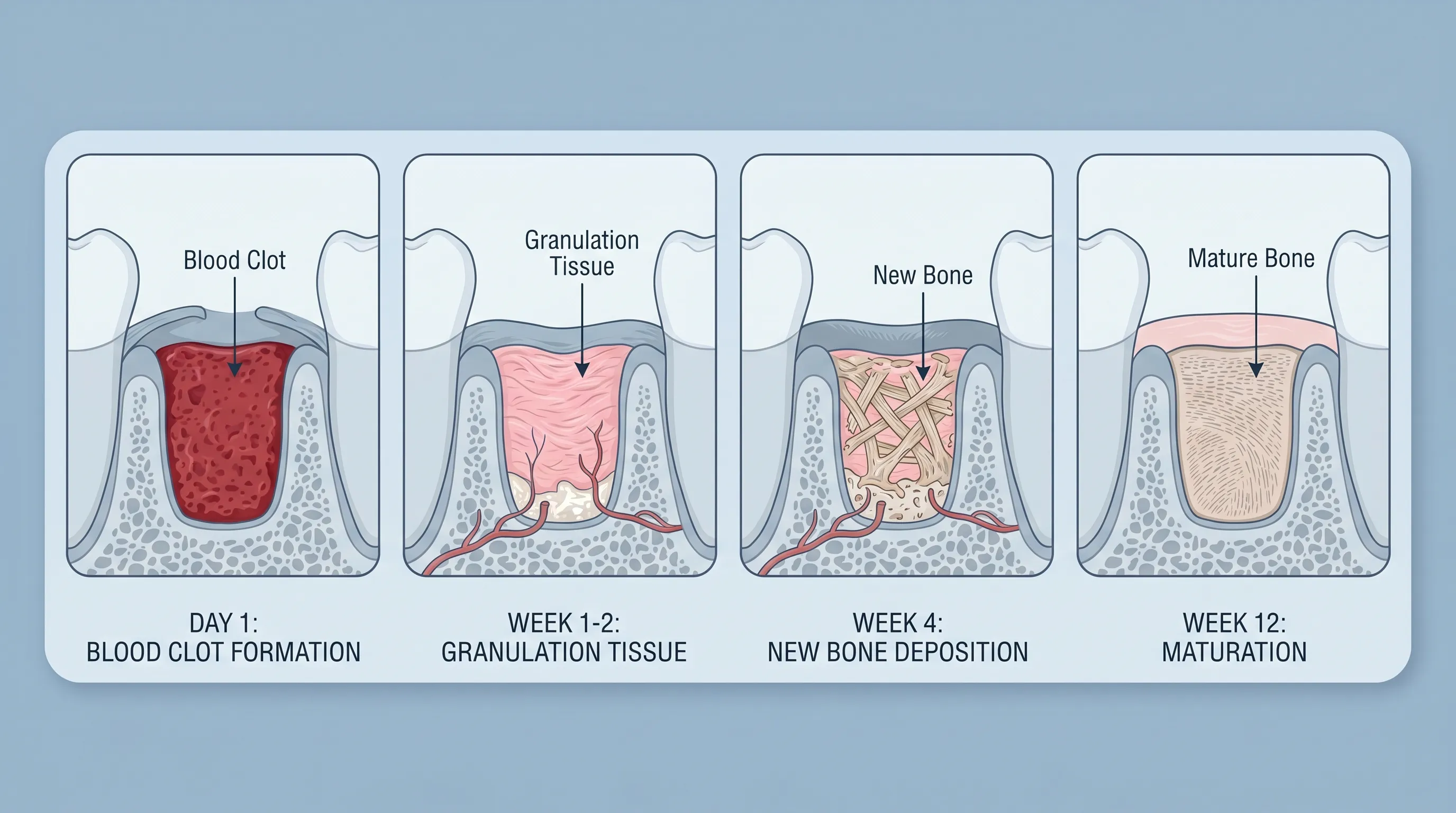 Anatomical illustration showing cross-section of healing dental socket with labeled blood clot, granulation tissue, and inflammatory markers