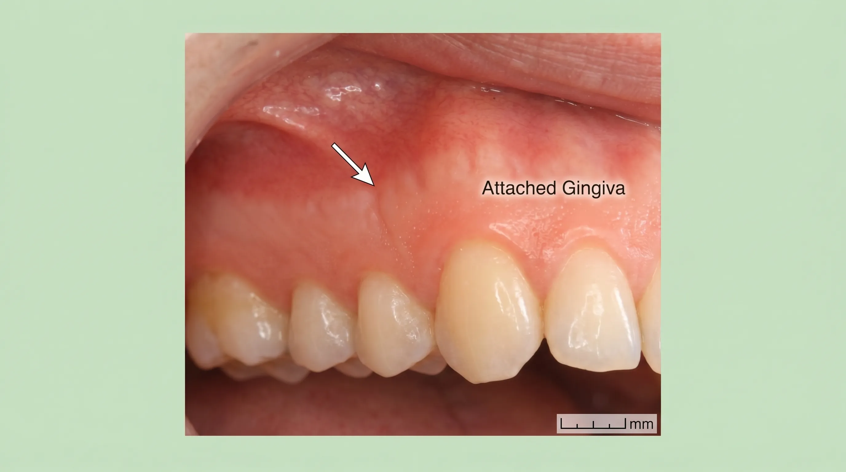 Close-up clinical photograph of healthy gingival tissue with subtle anatomical landmarks, soft natural lighting, medical photography style, educational focus