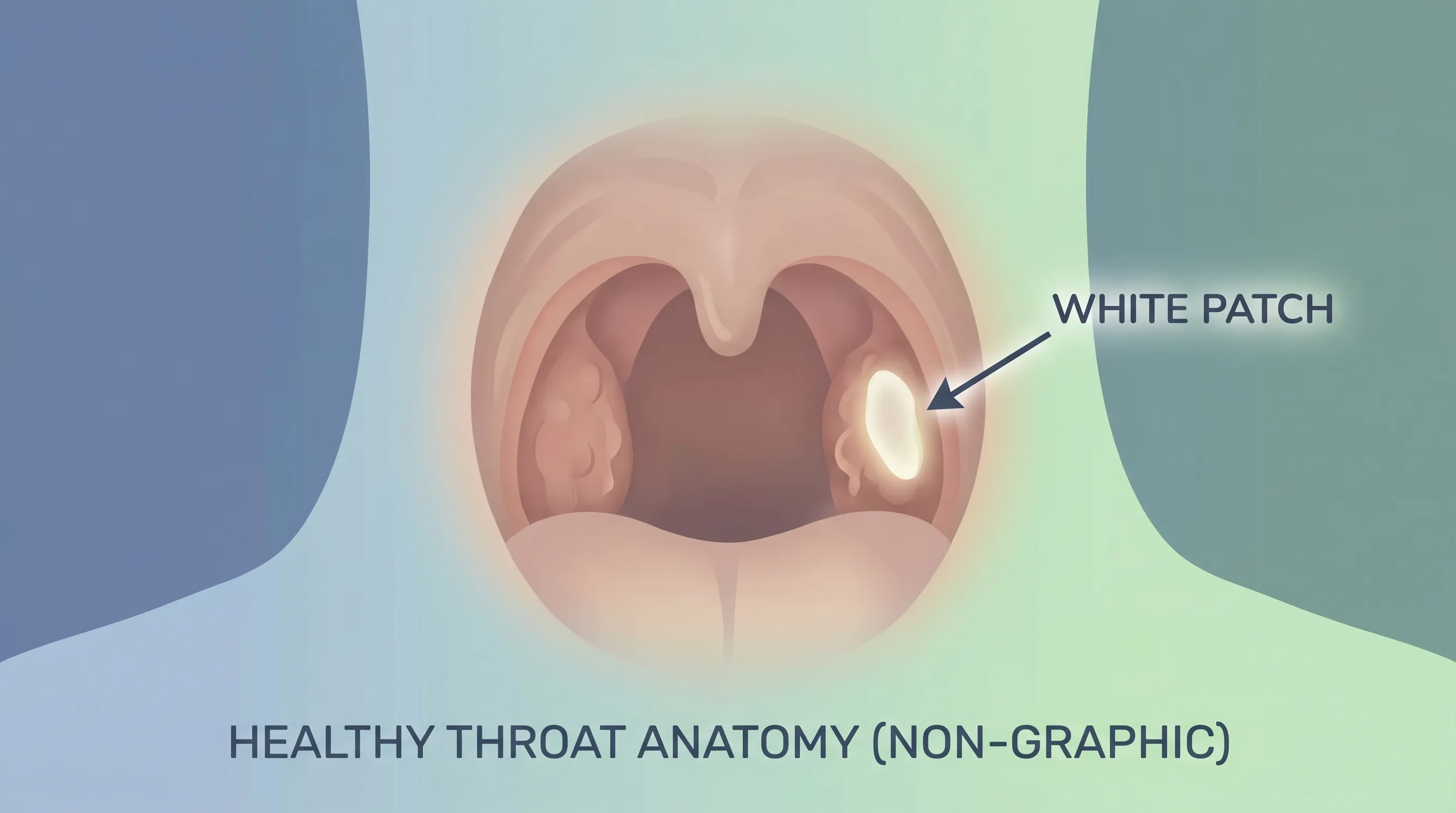 A detailed medical illustration showing healthy throat anatomy with highlighted areas of potential white patches, designed for educational clarity