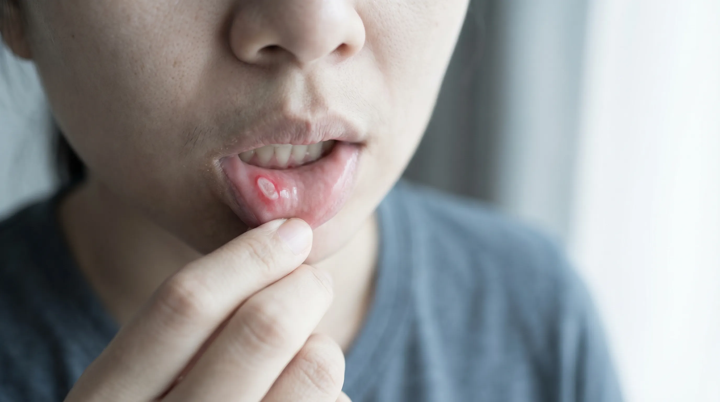 A typical canker sore on the inside of the lower lip, showing a white center and red border.