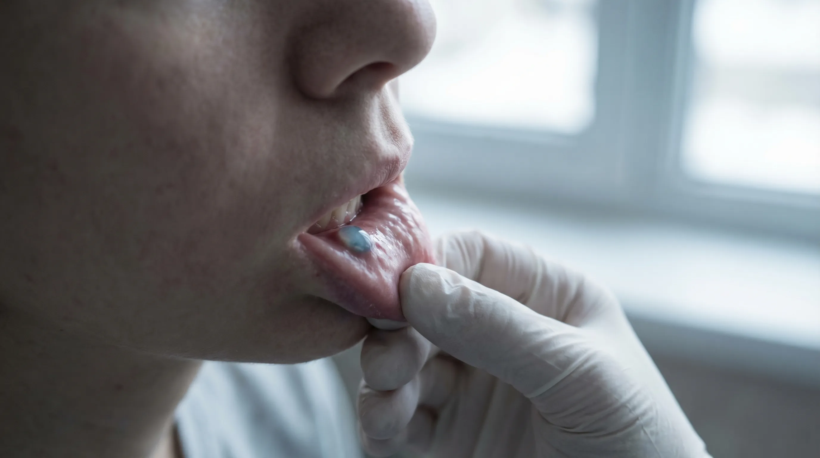 A translucent, bluish mucocele cyst on the inside of a person's lower lip.