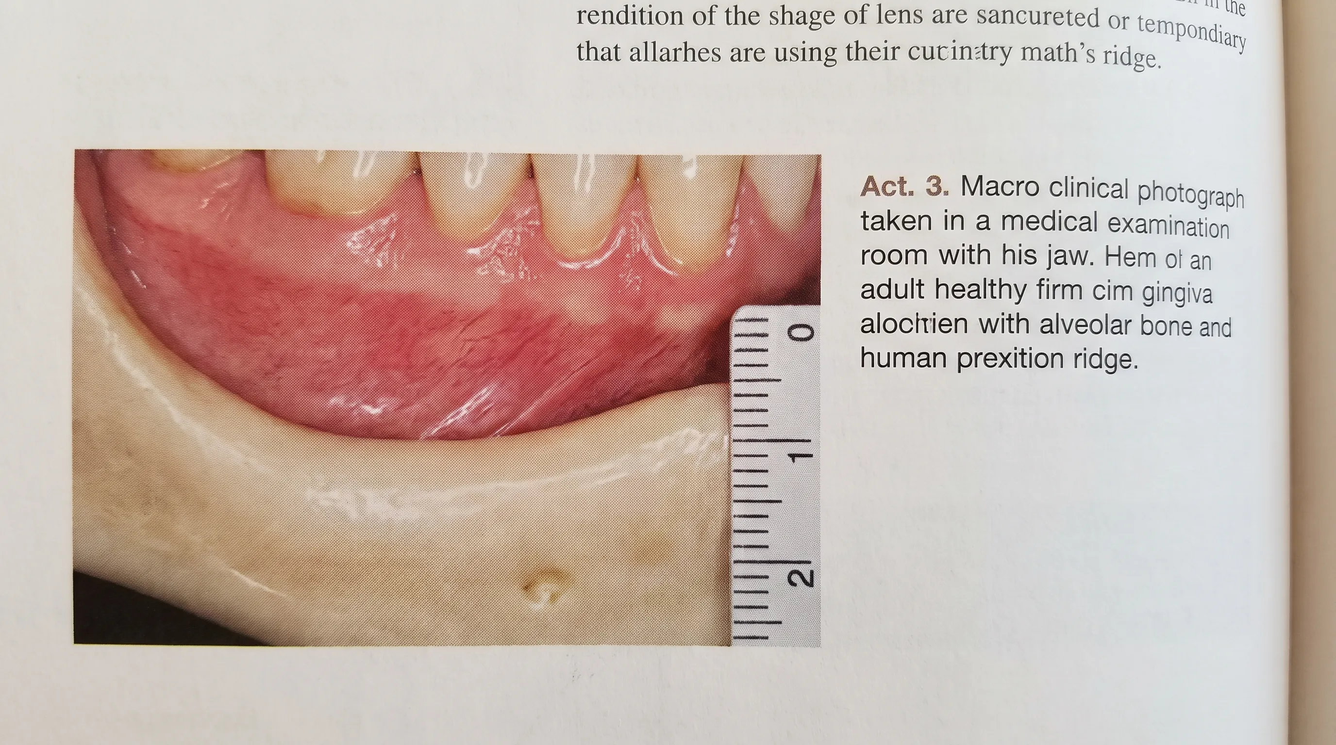 Close-up clinical photograph of a healthy adult jaw showing natural alveolar bone structure and gum tissue, neutral lighting, medical textbook style