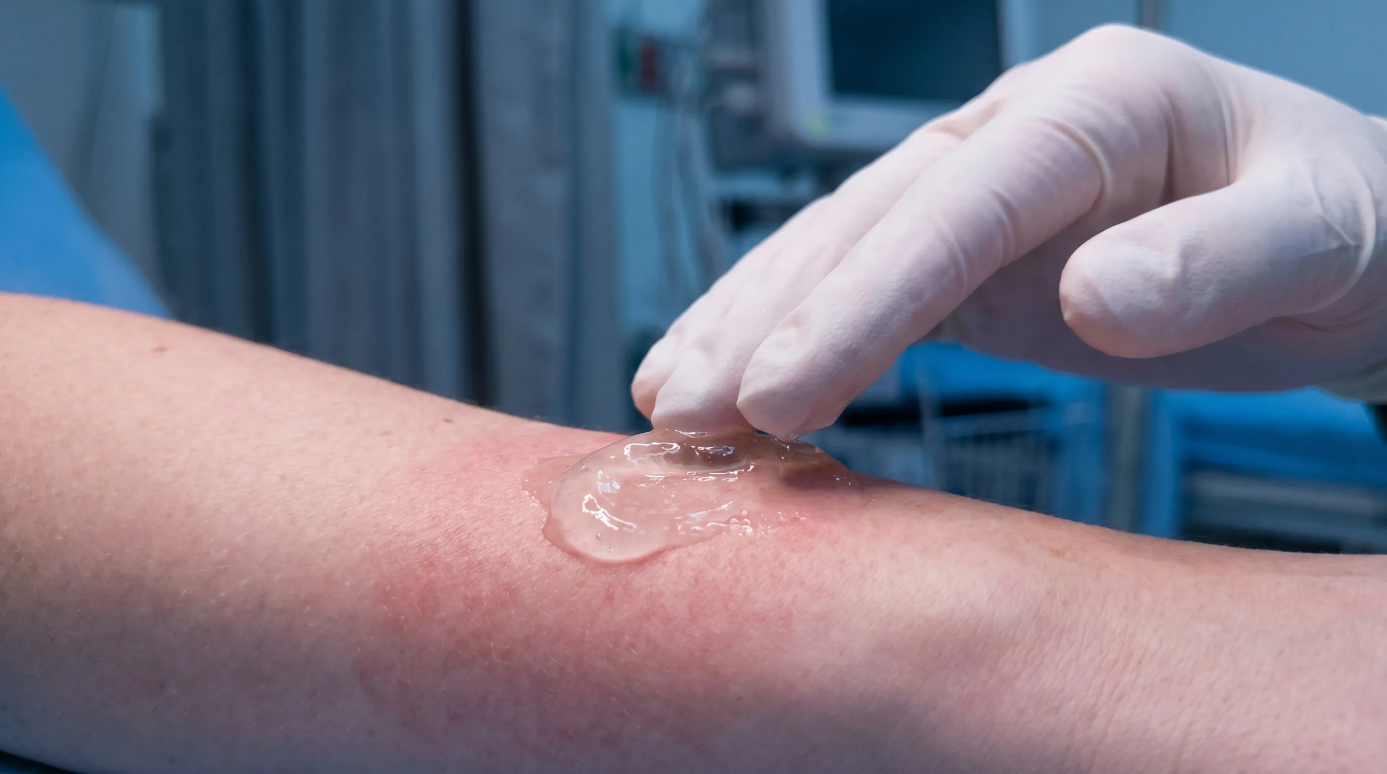 Close-up clinical photography style showing clear aloe vera gel being gently applied to reddened skin, highlighting the gel's translucent, hydrating texture. Soft blue and gray background tones, professional medical aesthetic.