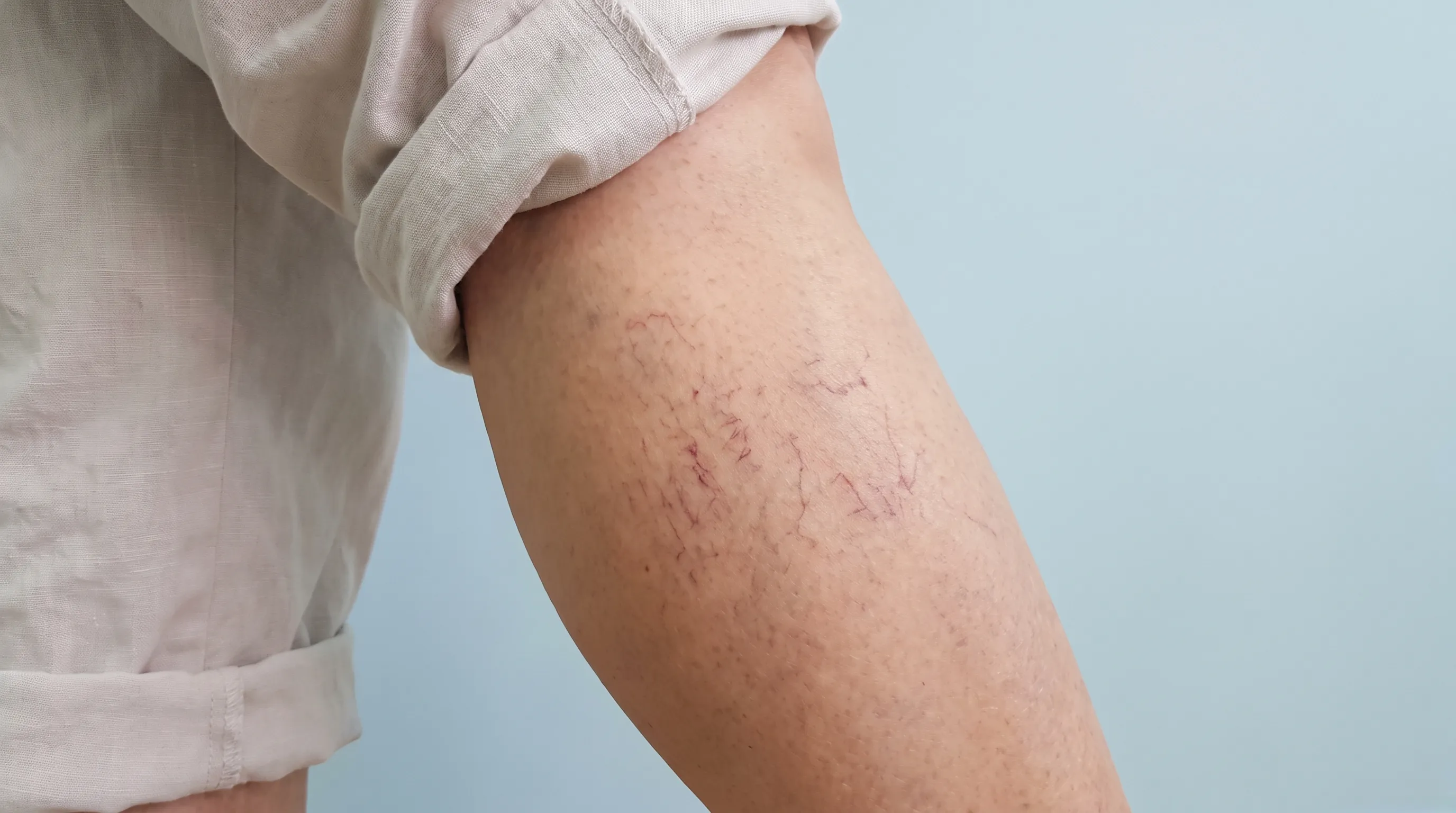 close-up of lower legs showing mild spider veins in natural lighting