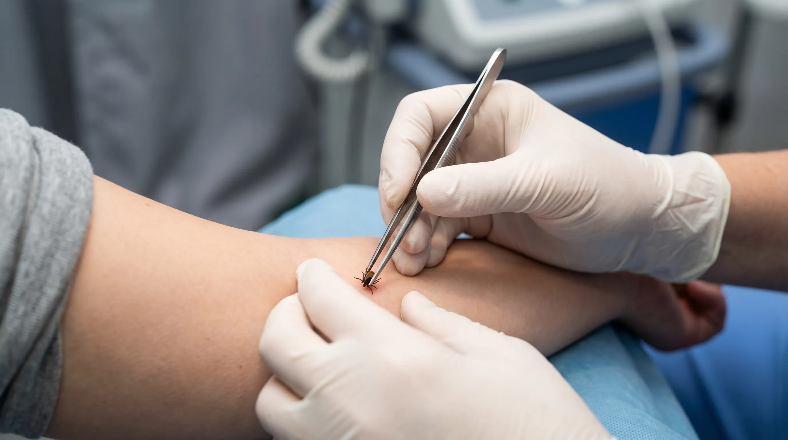 Proper positioning of fine-tipped tweezers grabbing a tick by its head, right where it enters the skin.