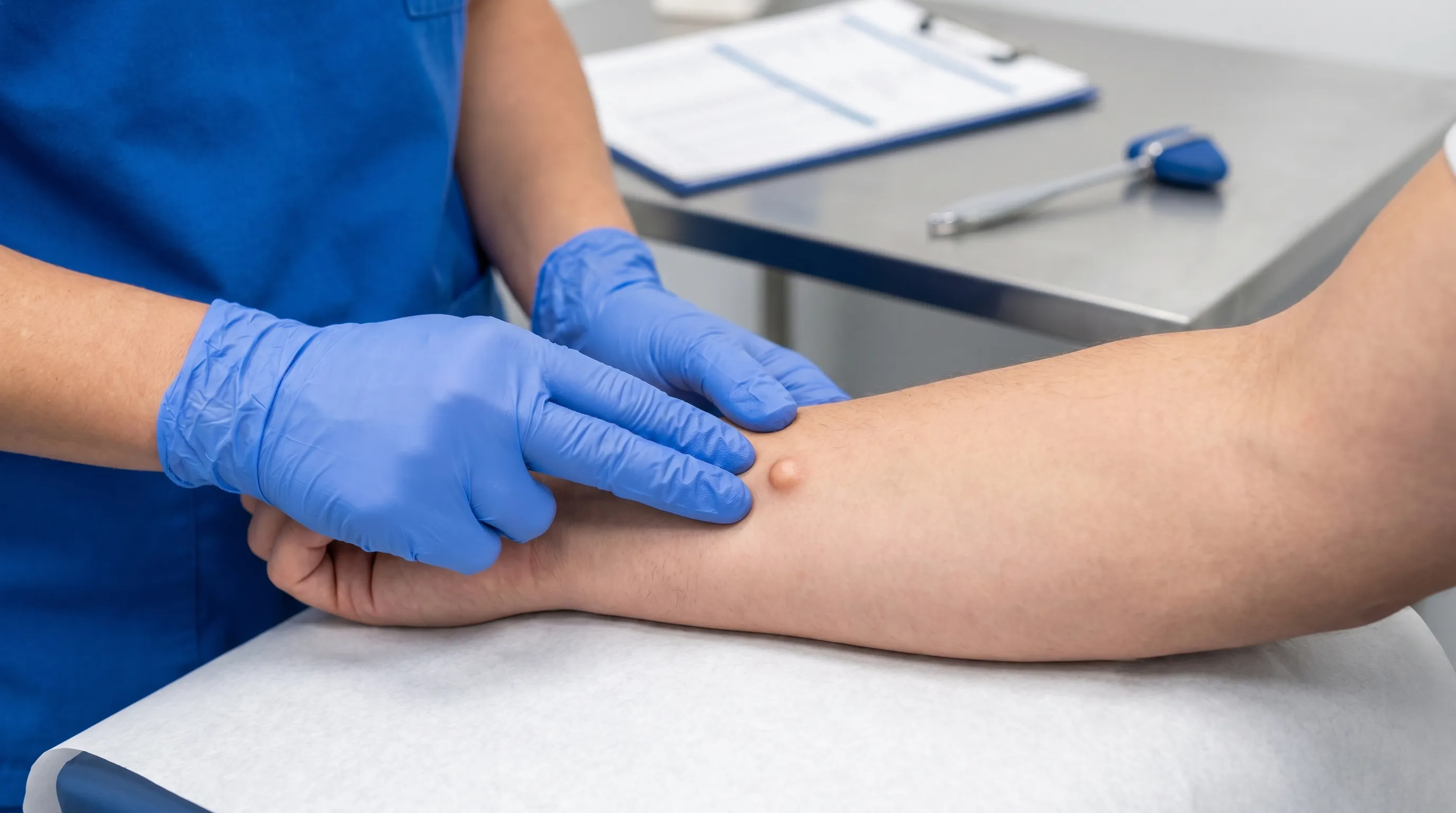 Photographie clinique en gros plan d'un professionnel de santé palpant délicatement l'avant-bras d'un patient pour évaluer une excroissance sous-cutanée bénigne, illustrant les techniques d'examen physique standard dans un cabinet médical lumineux