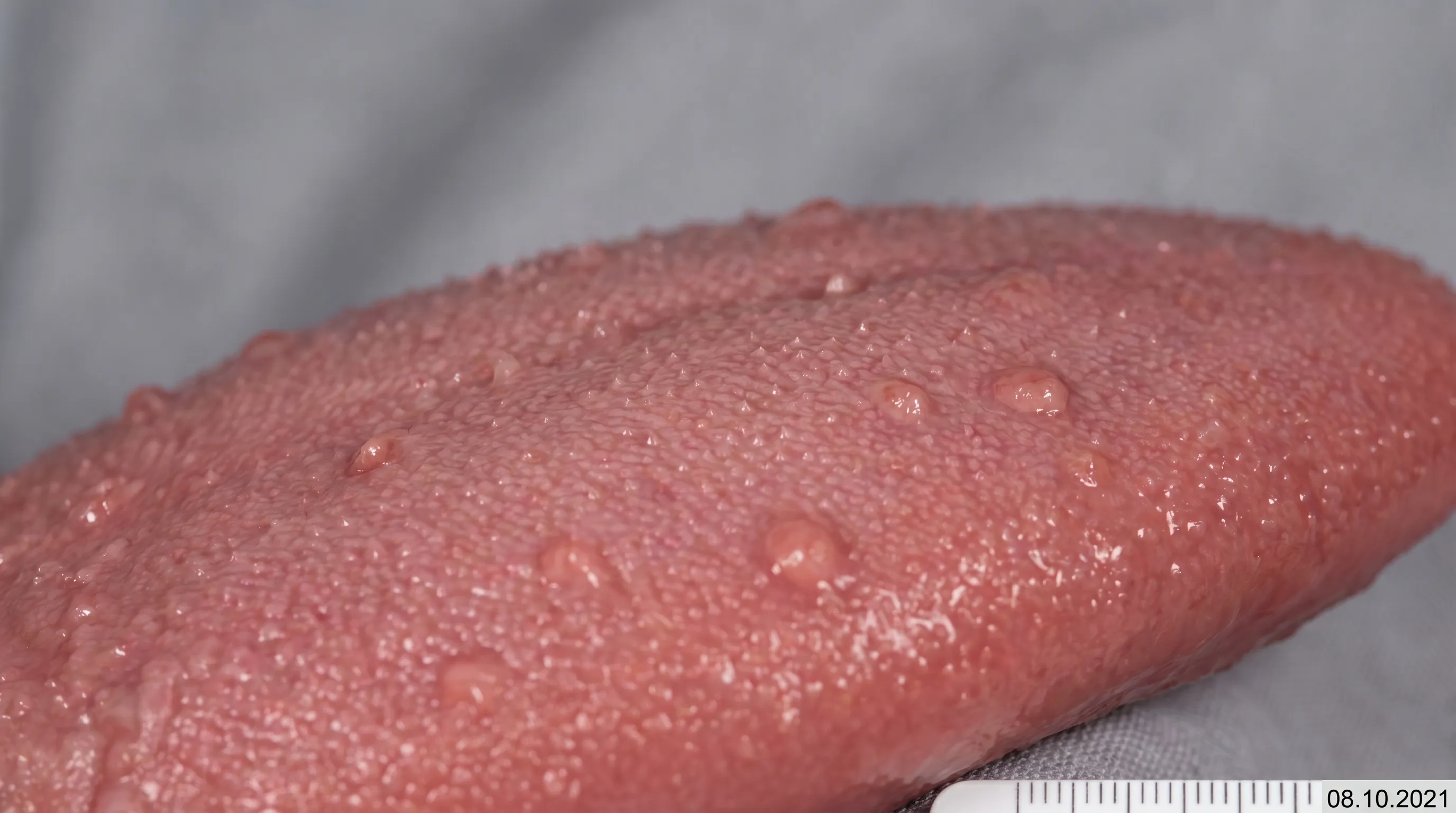A close-up view of a healthy tongue with visible papillae under soft clinical lighting