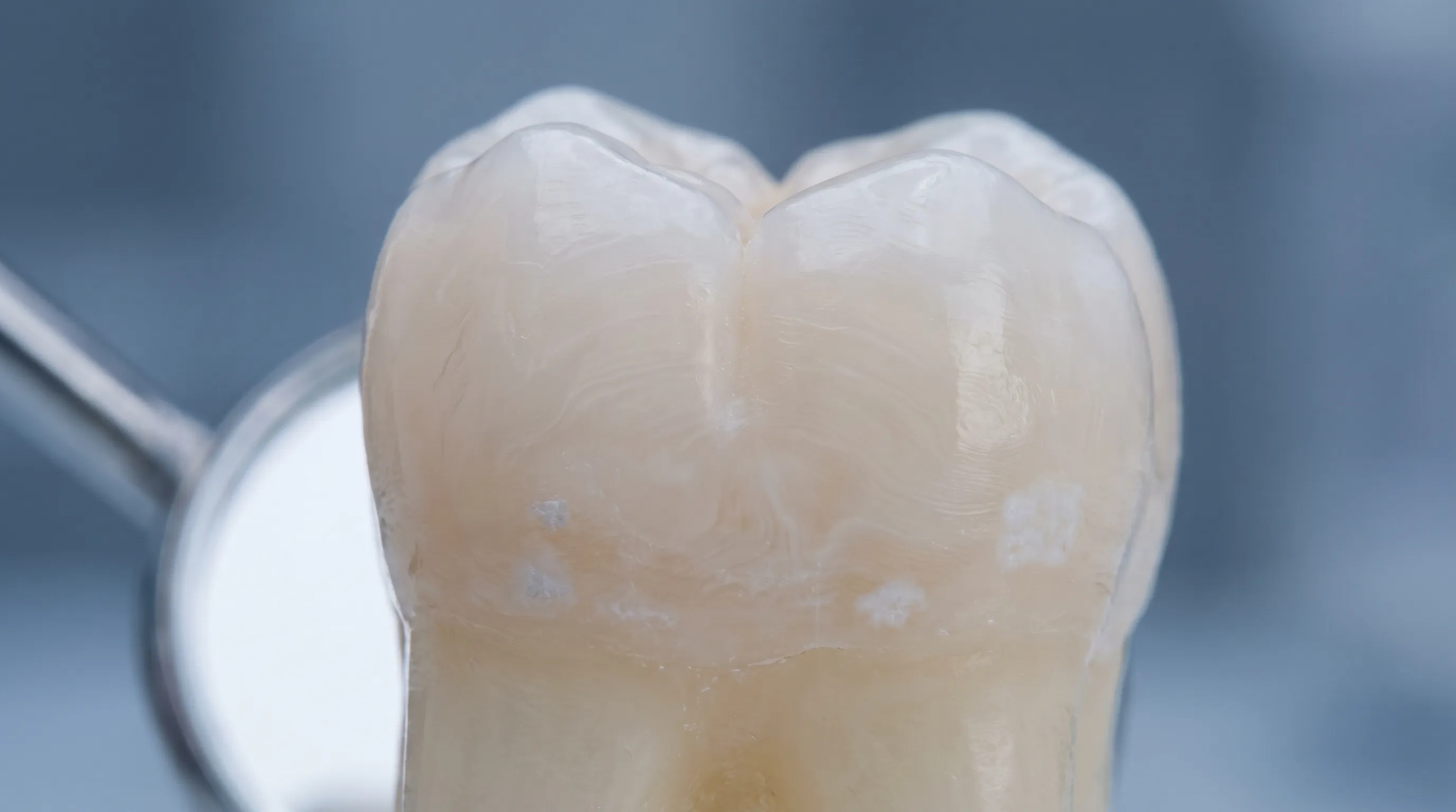 Nahaufnahme einer klinischen Darstellung früher weißer Fleckläsionen und einer Demineralisierung des Zahnschmelzes unter der Oberfläche bei diagnostischer Beleuchtung