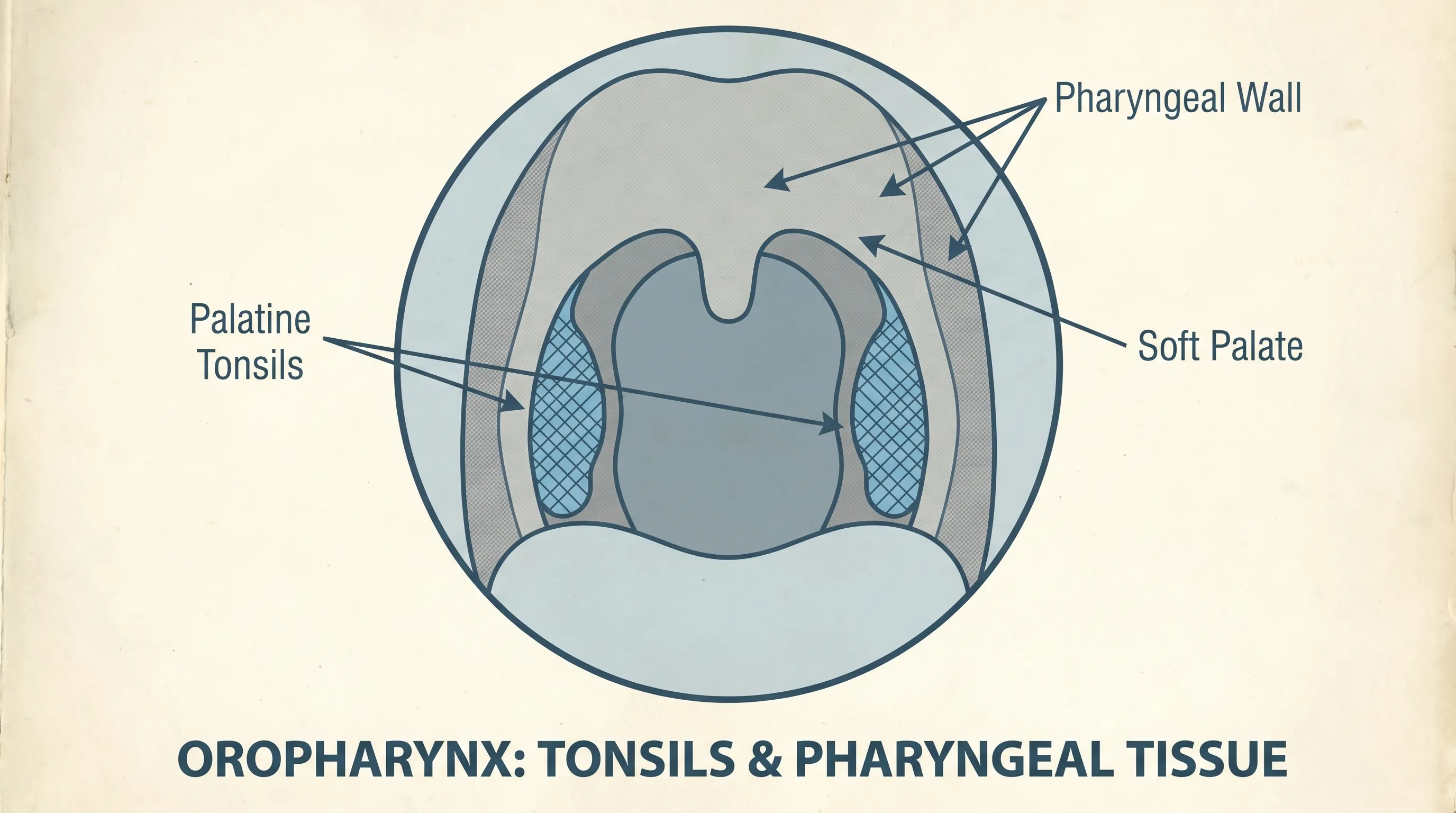 Clinical illustration showing healthy vs inflamed oropharyngeal tissue with tonsillar crypts and mucosal variations