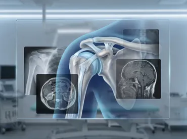 Luxación posterior de hombro: Guía completa de síntomas, diagnóstico y recuperación