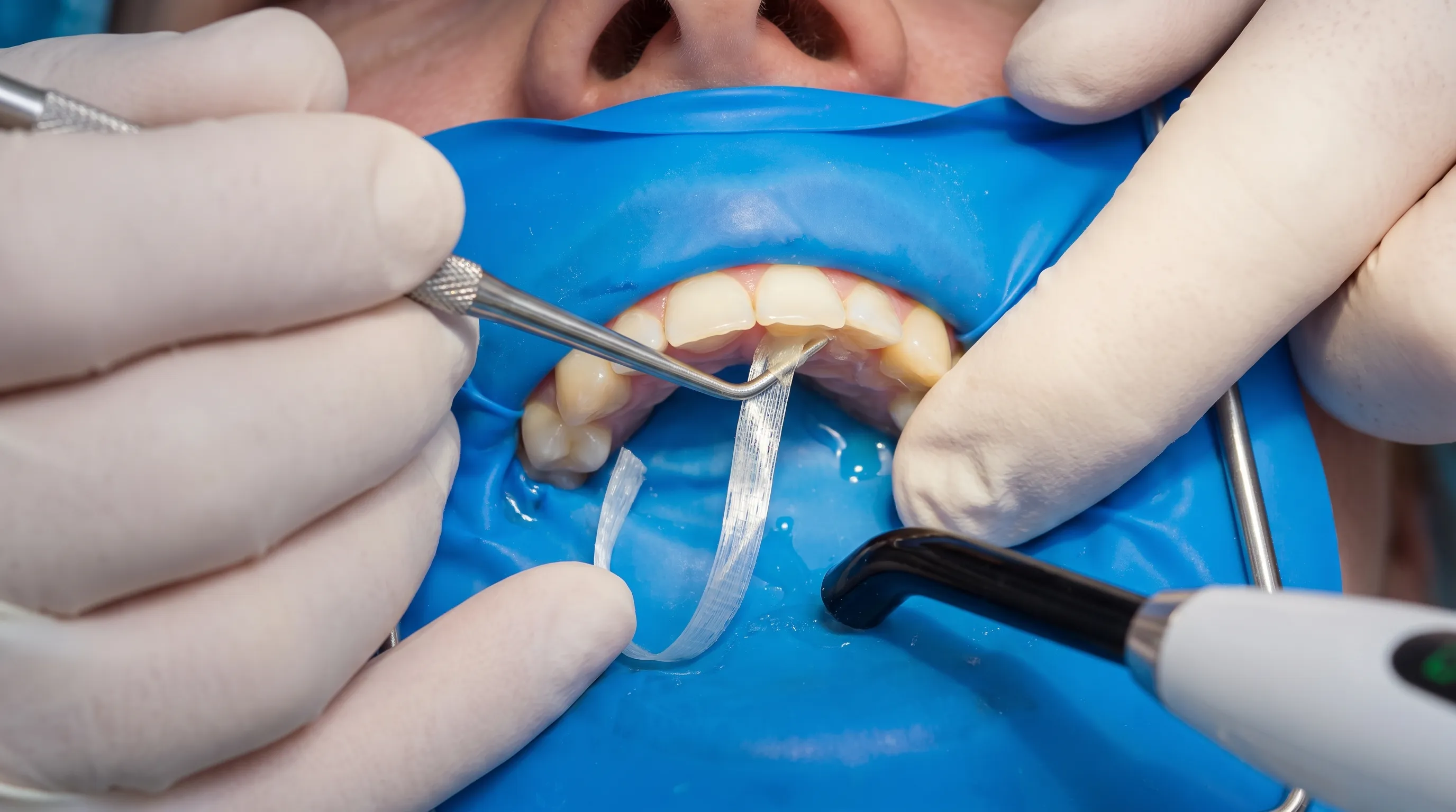 Close-up of dental splinting procedure showing fiber-reinforced composite material stabilizing teeth